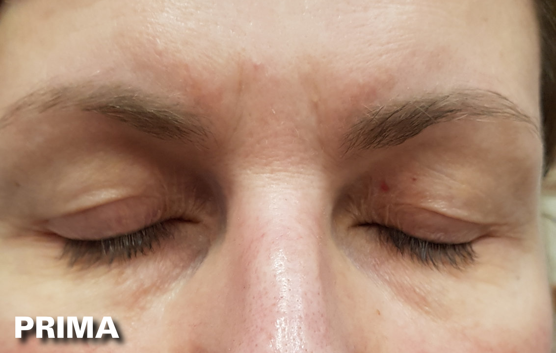 Blefaroplastica - Prima