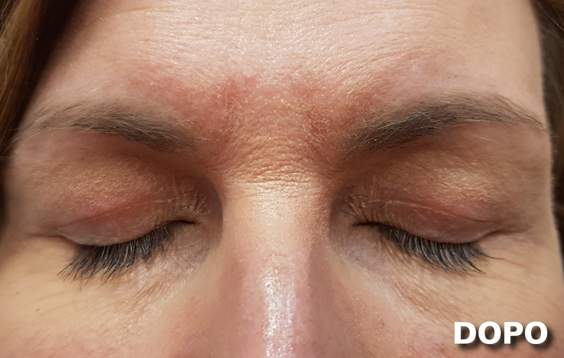 Blefaroplastica - Dopo