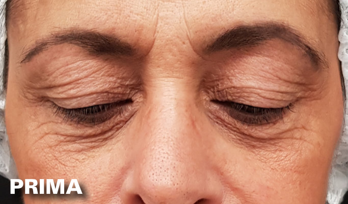 Blefaroplastica - Prima
