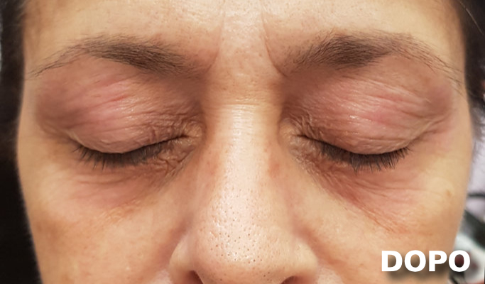 Blefaroplastica - Dopo
