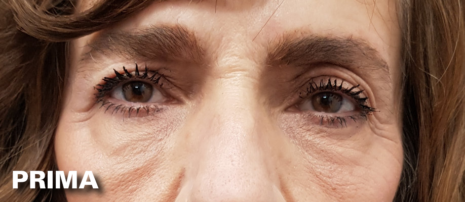 Blefaroplastica - Prima
