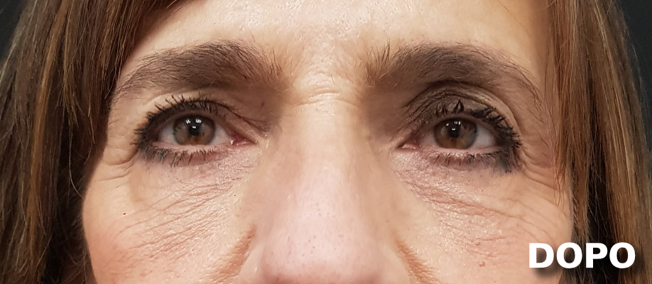 Blefaroplastica - Dopo